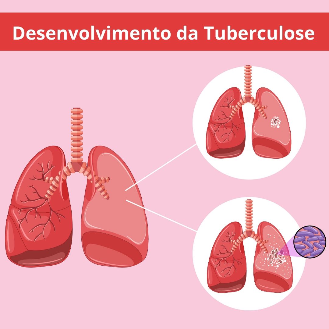 Desenvolvimento da Tuberculose